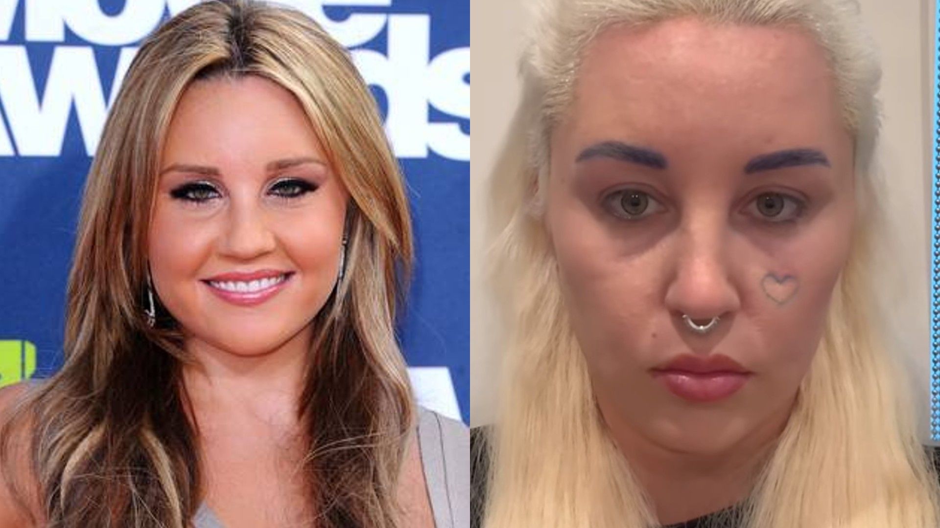 Amanda Bynes przed i po blefaroplastyce