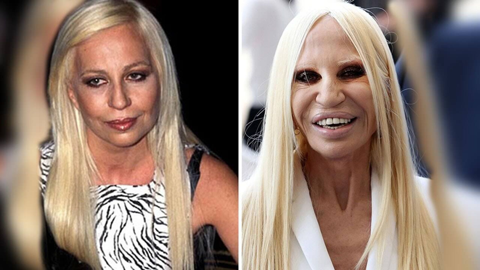 Donatella Versace przed i po operacjach plastycznych